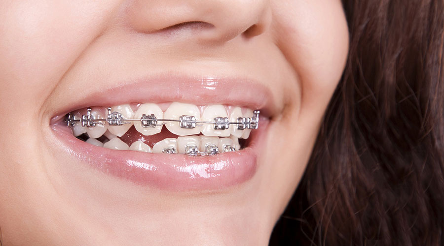 dental braces