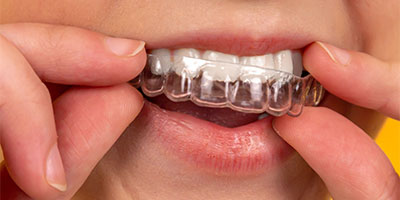 Invisible Clear Aligners For Crowded Teeth